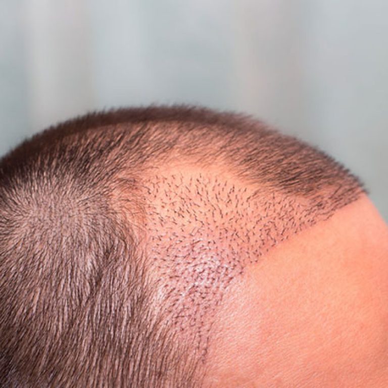 أفضل دكتور زراعة شعر