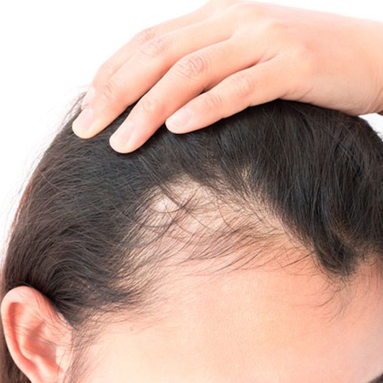 أفضل دكتور زراعة شعر الجبهة للنساء