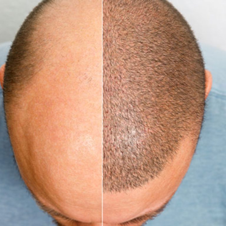 أفضل مركز زراعة شعر
