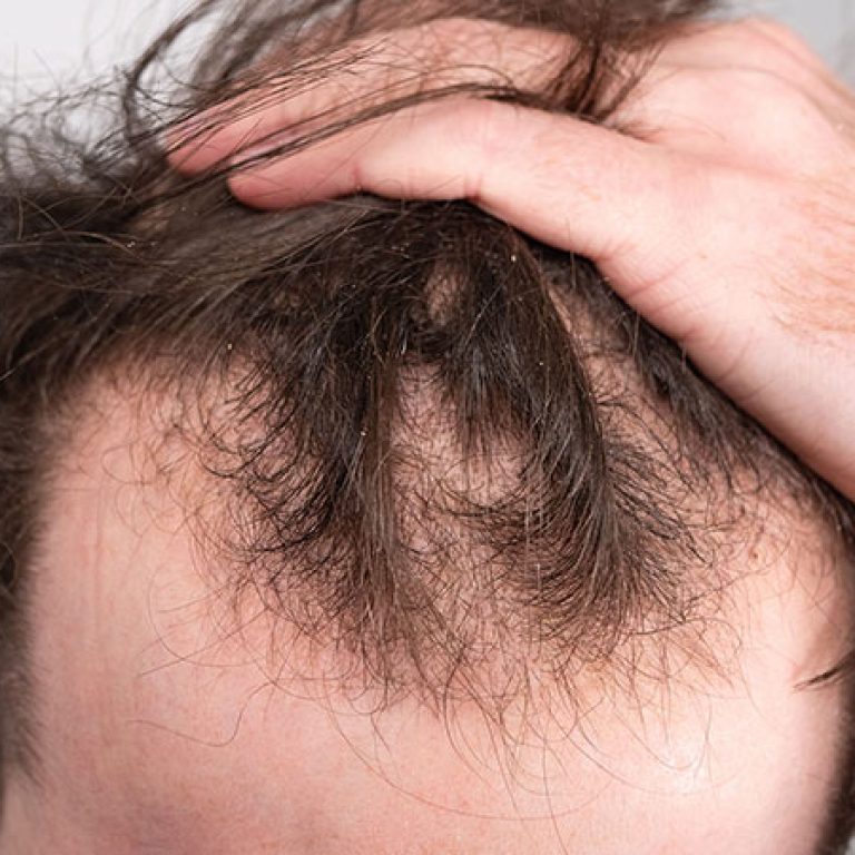 أنواع زراعة الشعر