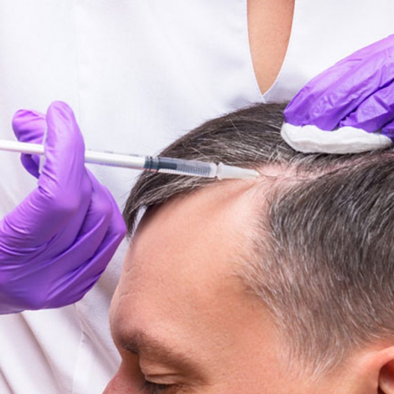 ابر البلازما بعد زراعة الشعر