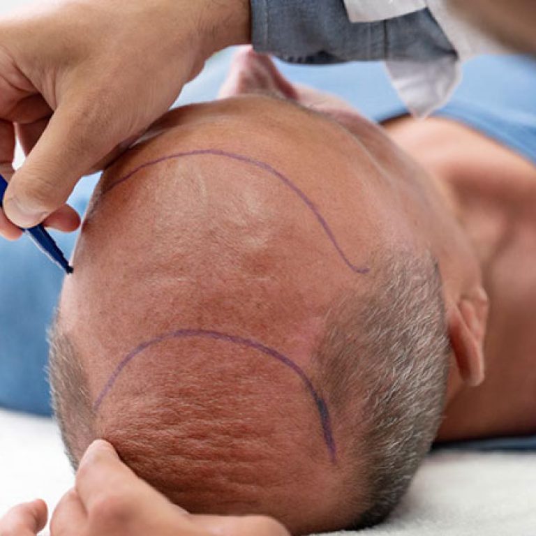 احدث الطرق لزراعة الشعر