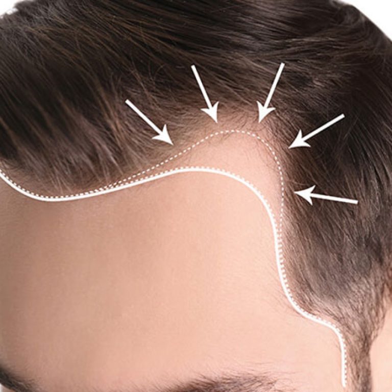 احدث تقنيات زراعة الشعر