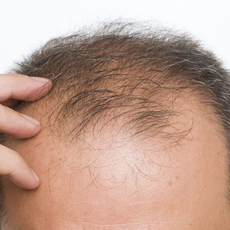 احدث تقنية لزراعة الشعر