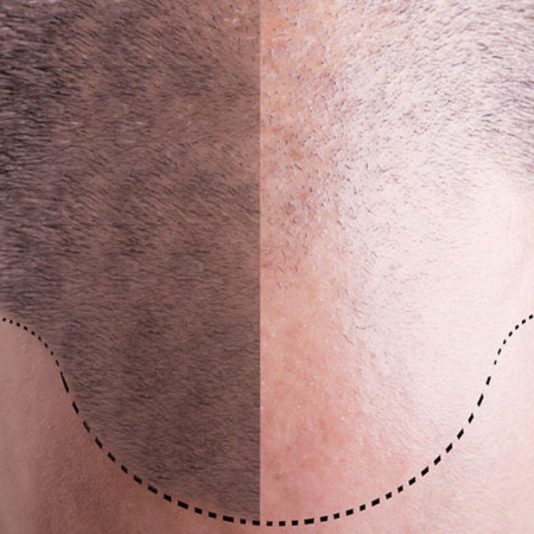 احدث طرق زراعة الشعر