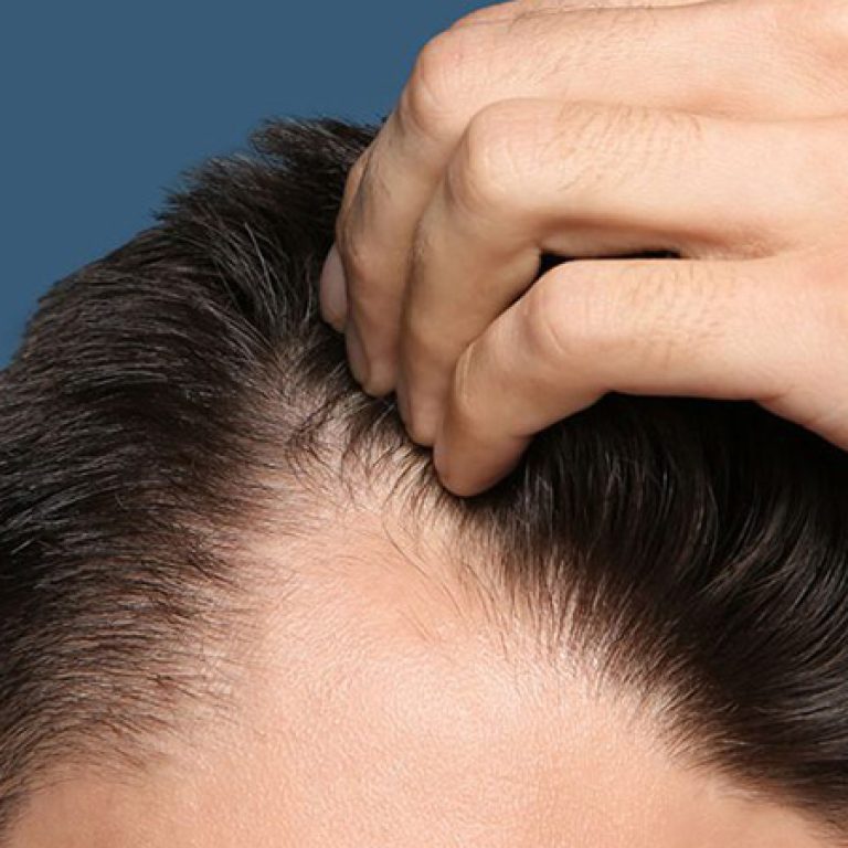 اخر تقنيات زراعة الشعر