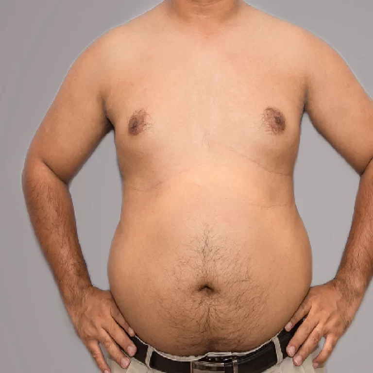 اسرع علاج للتثدي عند الرجال