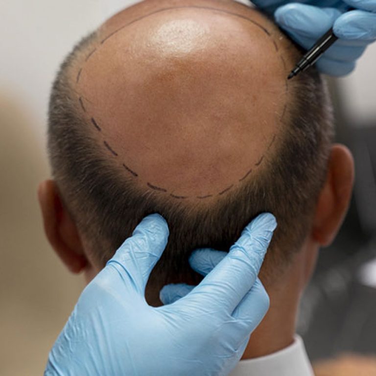 اسعار زراعة الشعر