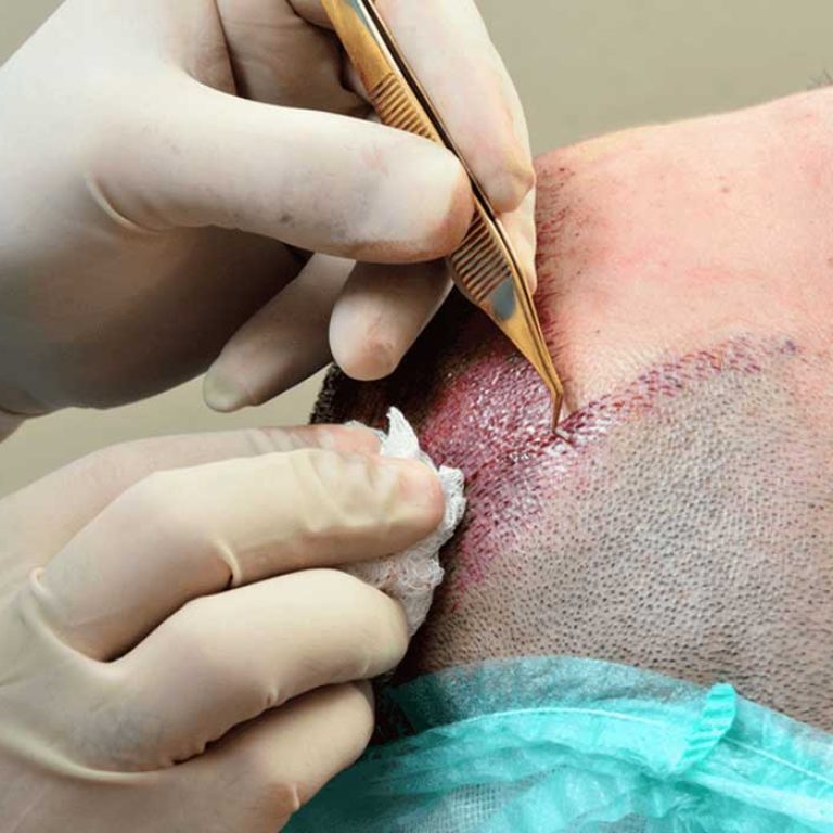 اضرار زراعة الشعر