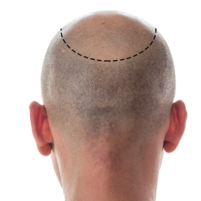 افضل تقنيات زراعة الشعر
