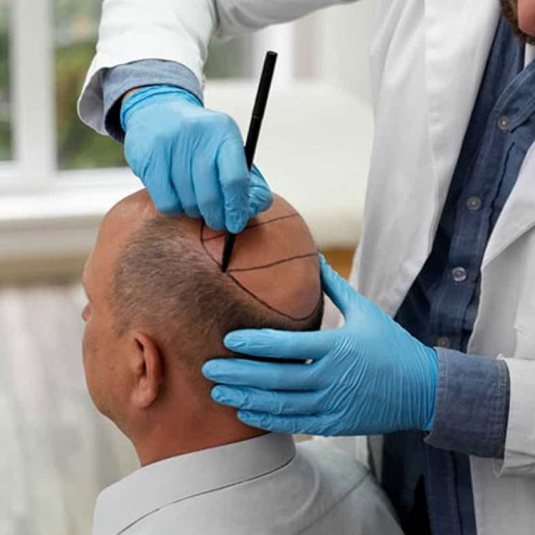 افضل دكتور في زراعة الشعر