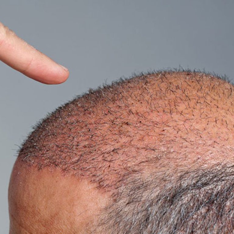 افضل دولة لزراعة الشعر