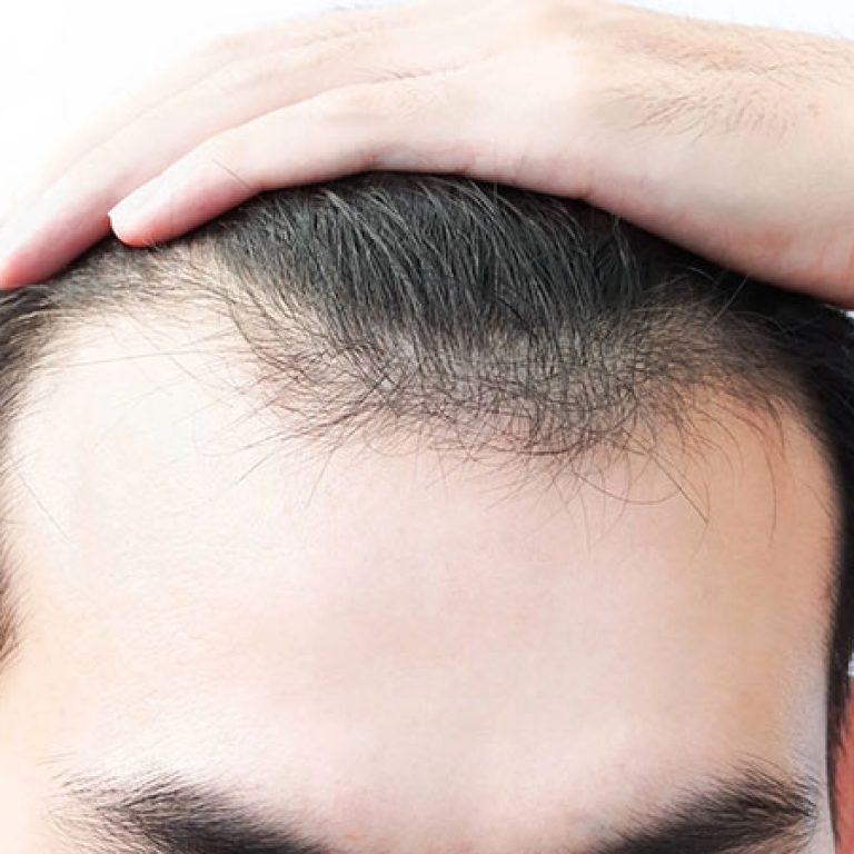 افضل طريقة لزراعة الشعر