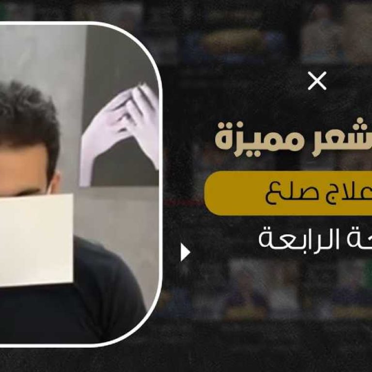 افضل علاج للصلع الوراثي