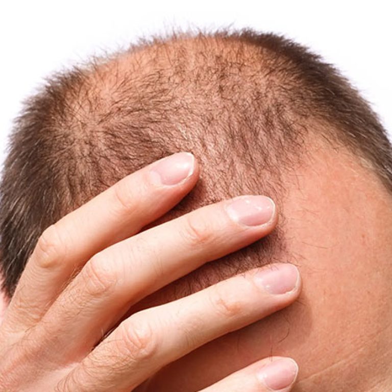افضل مركز لزراعة الشعر