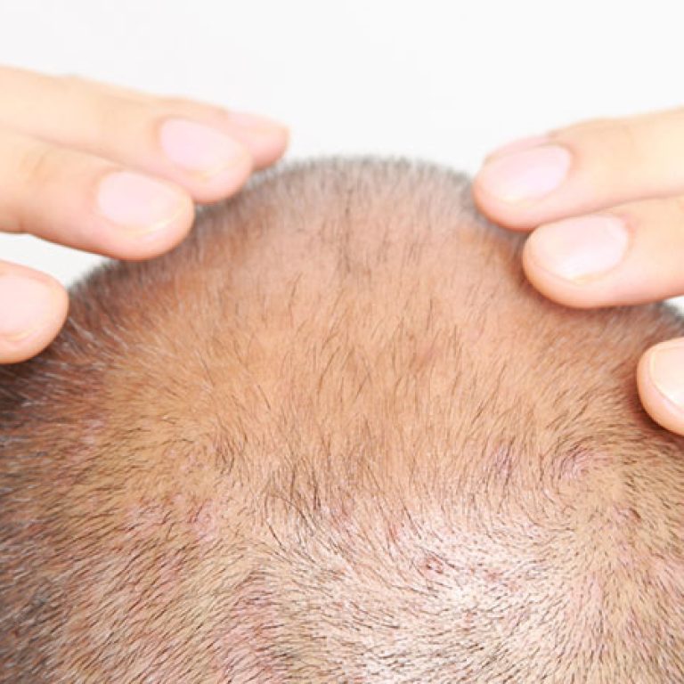 افضل مكان لزراعة الشعر