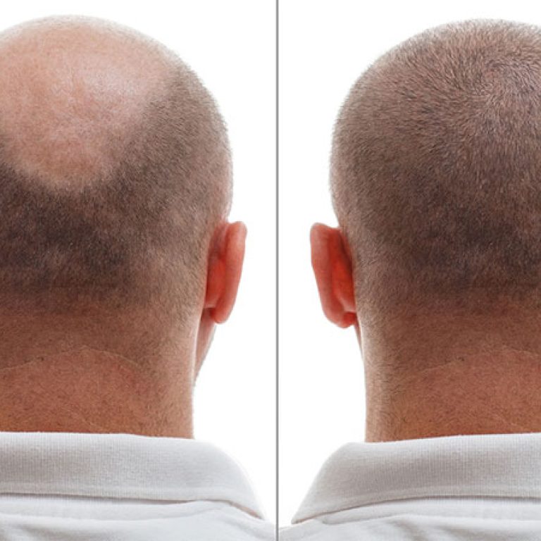 افضل نتائج زراعة الشعر