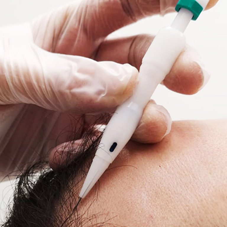 اقلام تشوي لزراعة الشعر