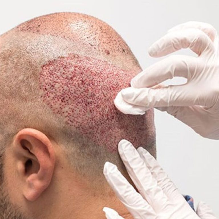 الاعراض الجانبية لزراعة الشعر