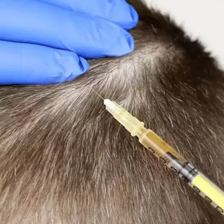 البلازما بعد زراعة الشعر