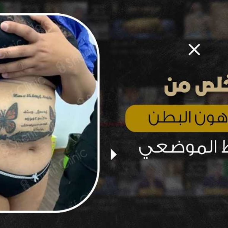 التخلص من بروز البطن