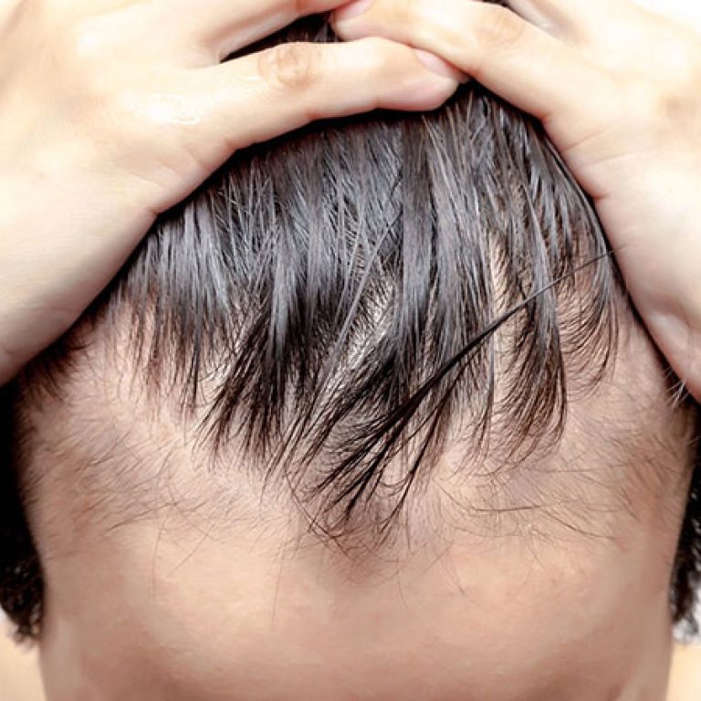 العمر المناسب لزراعة الشعر