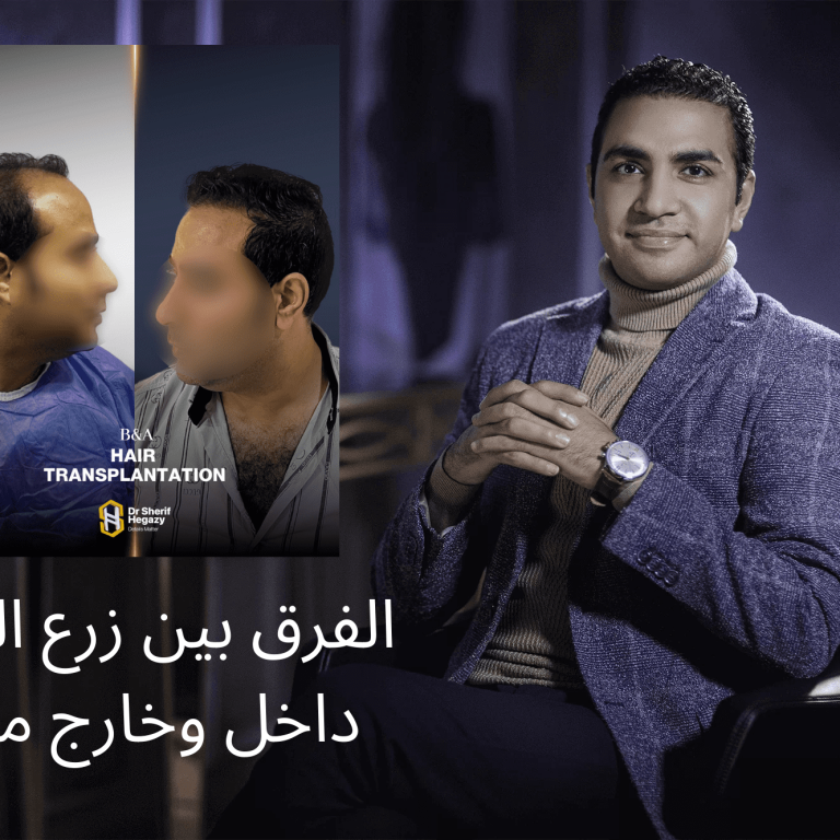 الفرق بين زرع الشعر داخل وخارج مصر