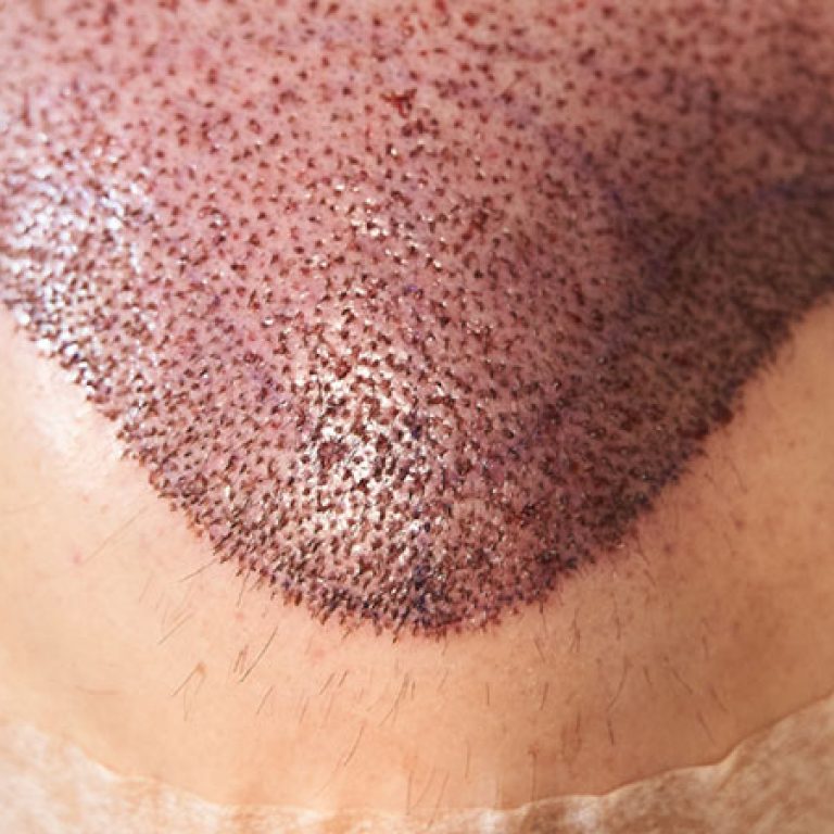 اليوم الخامس بعد زراعة الشعر