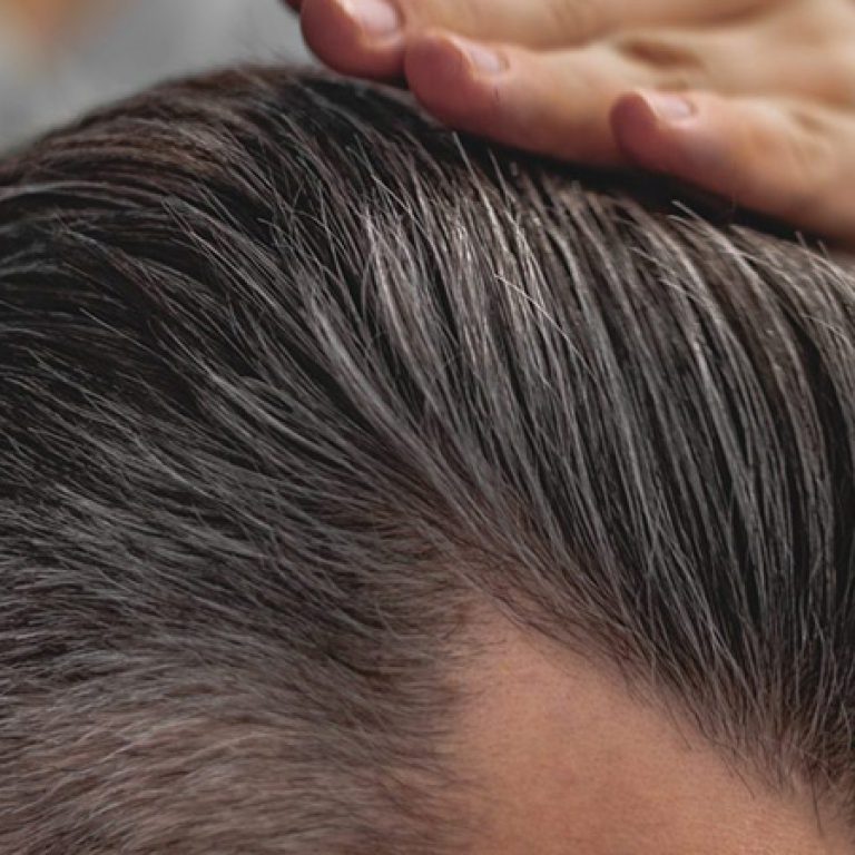 بالصور زراعة الشعر