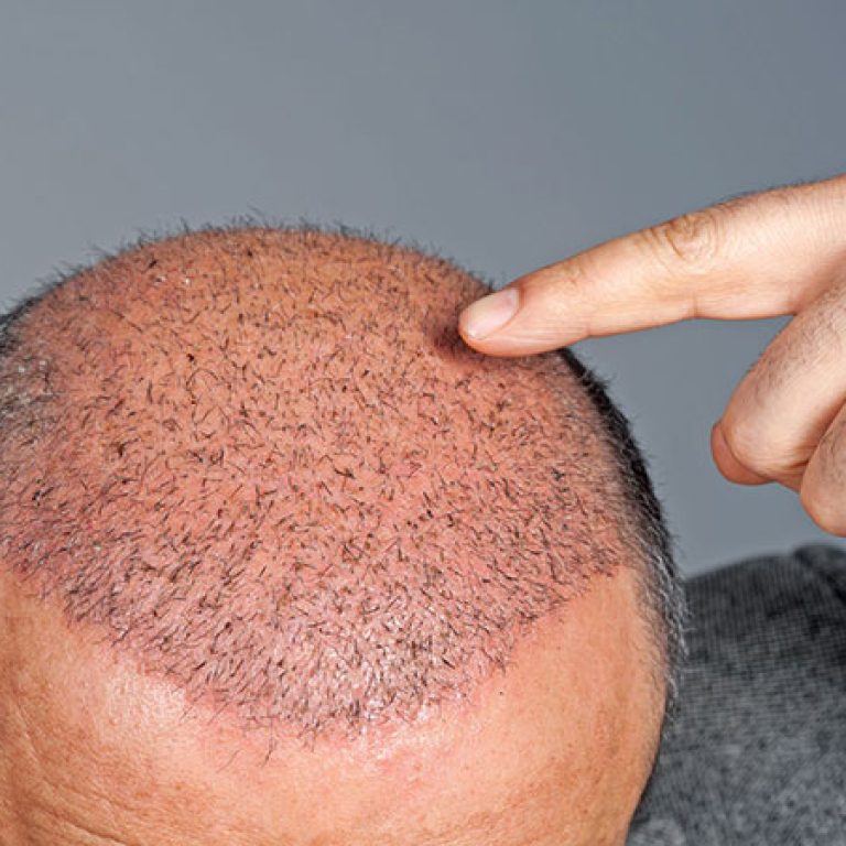 بديل زراعة الشعر