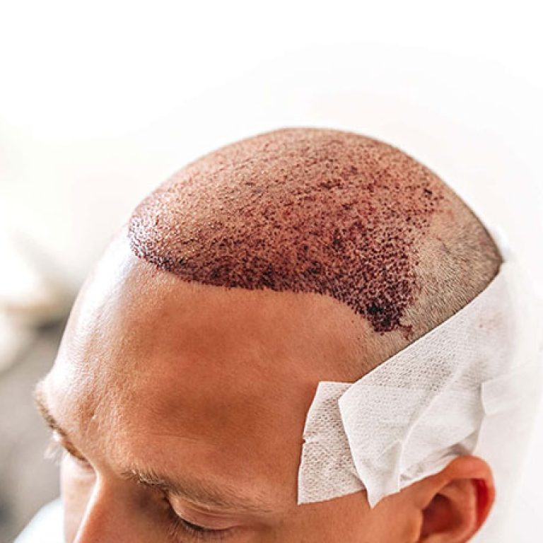 بعد 15 يوم من زراعة الشعر
