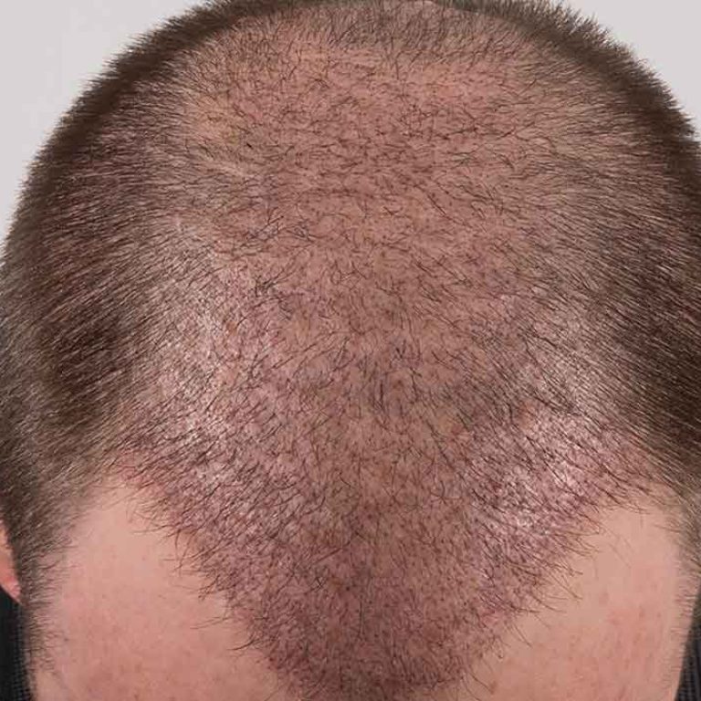 بعد زراعة الشعر بشهر