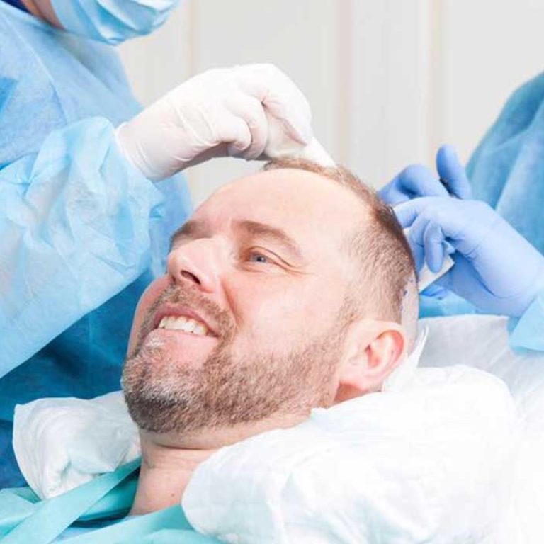 بعد زراعة الشعر بشهرين