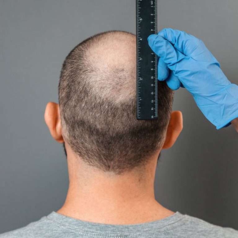 تجارب زراعة الشعر