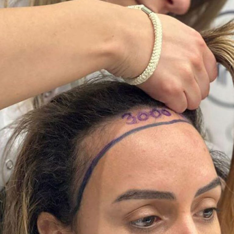 تجارب زراعة شعر الجبهة للنساء