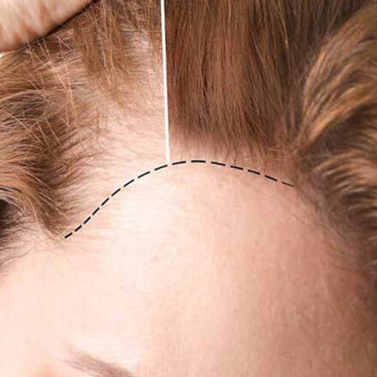 تجربتي في زراعة الشعر للنساء