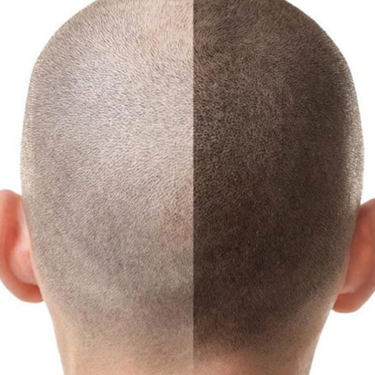 تجربتي مع زراعة الشعر