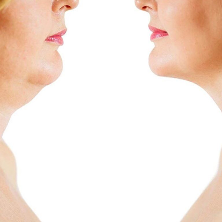 تجميل الرقبة قبل وبعد