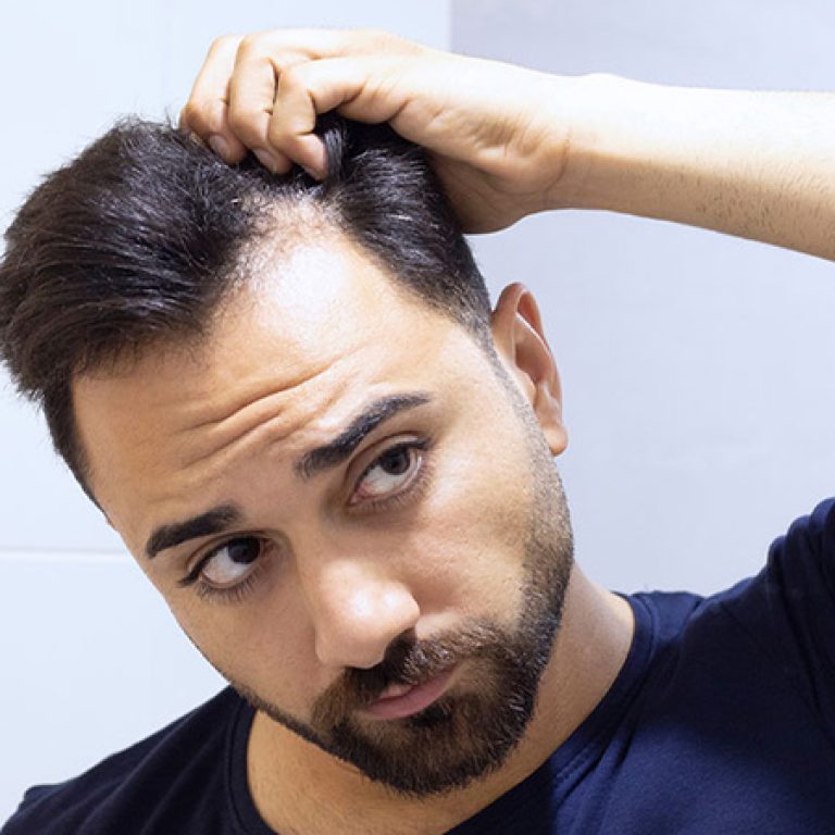 تساقط الشعر المزروع