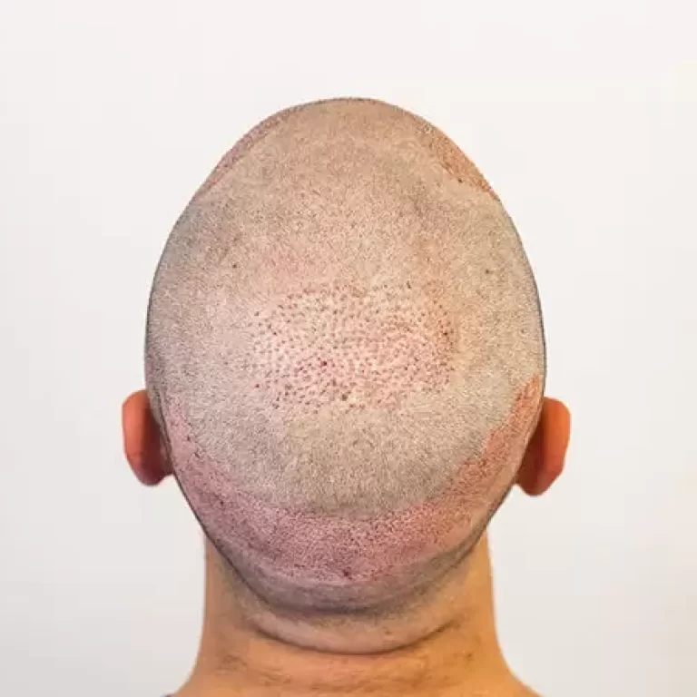 تساقط الشعر بعد زراعة الشعر