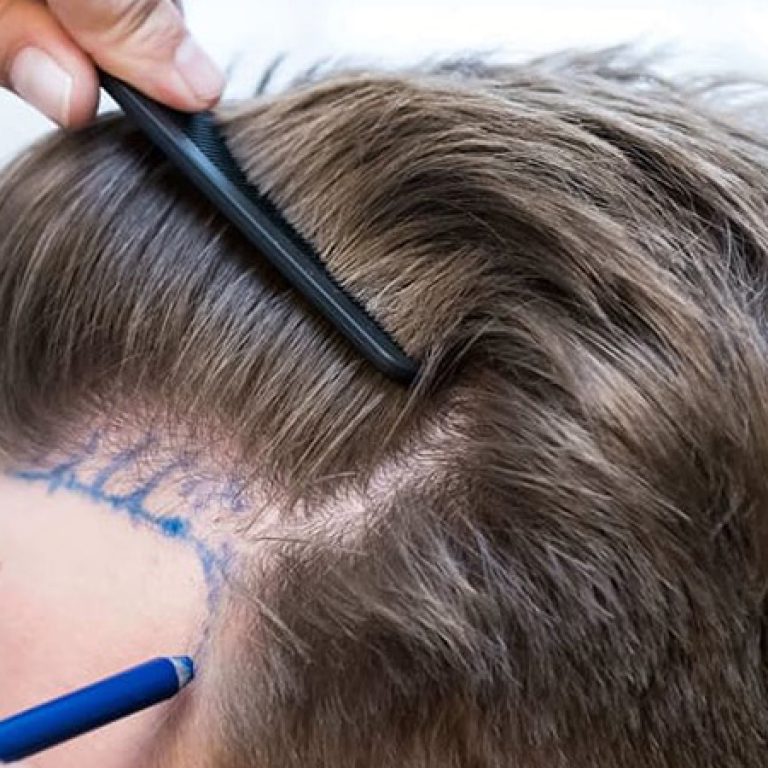 تعليمات بعد زراعة الشعر