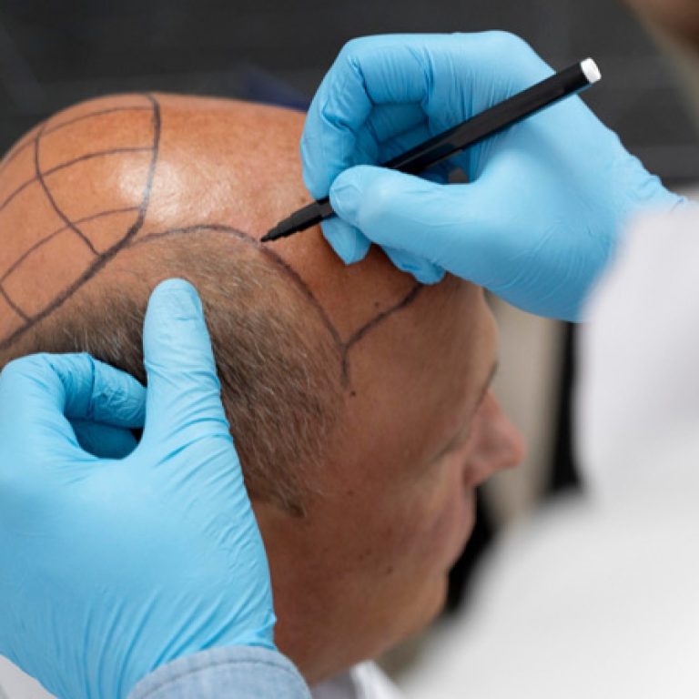 تقنيات زراعة الشعر