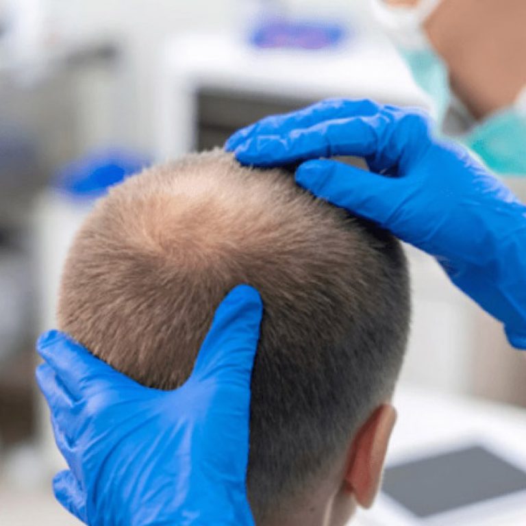 تقنية dhi لزراعة الشعر