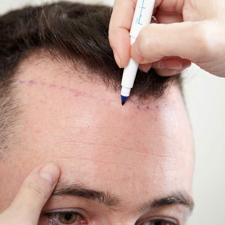 تقنية fue لزراعة الشعر