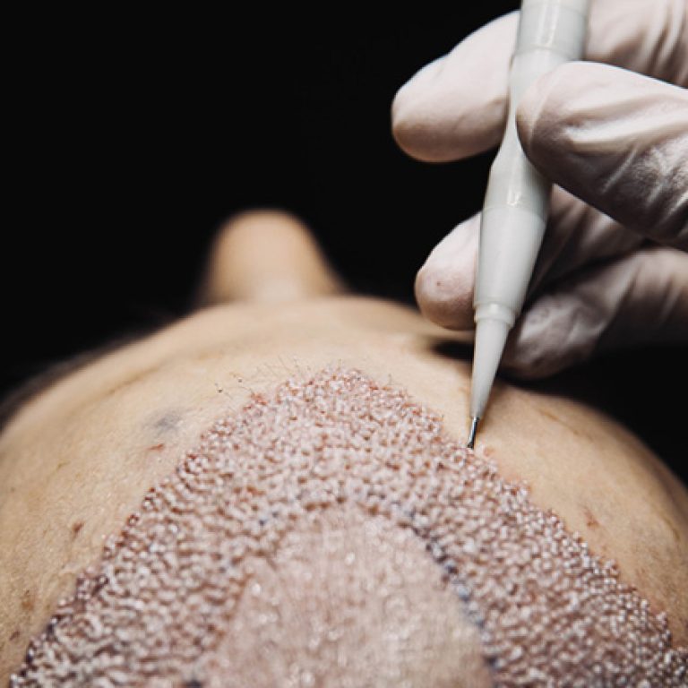 تقنية اقلام تشوي لزراعة الشعر