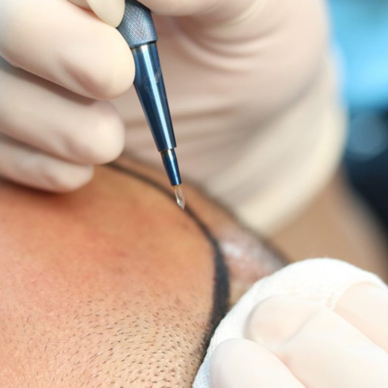 تقنية السفير لزراعة الشعر