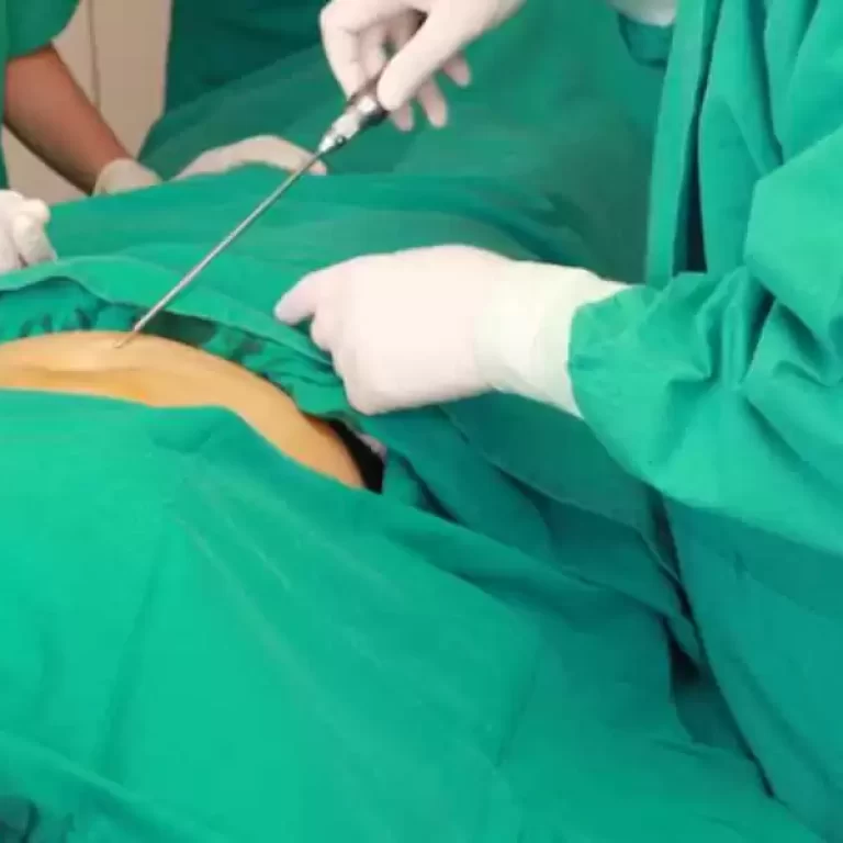 تقنية الفيزر لشفط الدهون