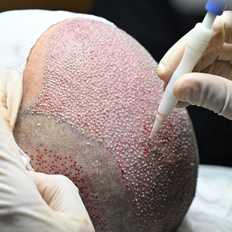 تقنية جديدة لزراعة الشعر