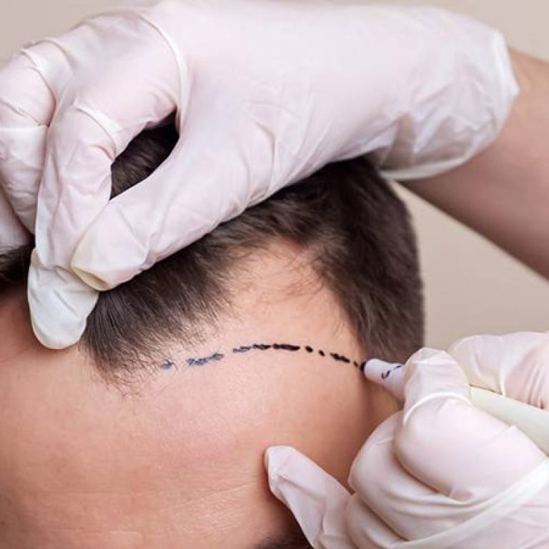 تقنية زراعة الشعر