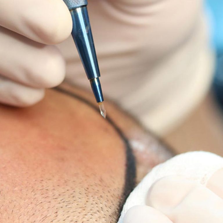 تقنية سفير لزراعة الشعر